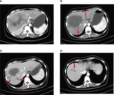 Prediction of bile duct injury after transarterial chemoembolization for hepatocellular carcinoma: Model establishment and verification